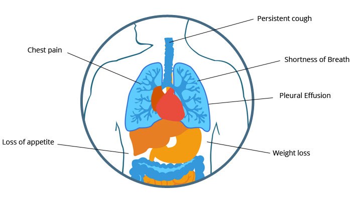 Mesothelioma Pathology Outlines